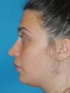 Rhinoplasty case #4126