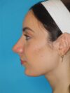 Rhinoplasty case #4168