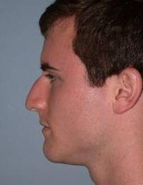 Rhinoplasty case #3516