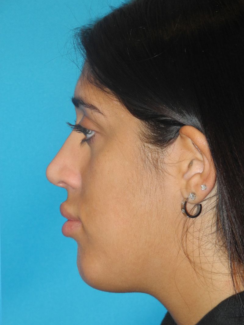 Chin Implant case #4340