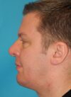 Chin Implant case #4374