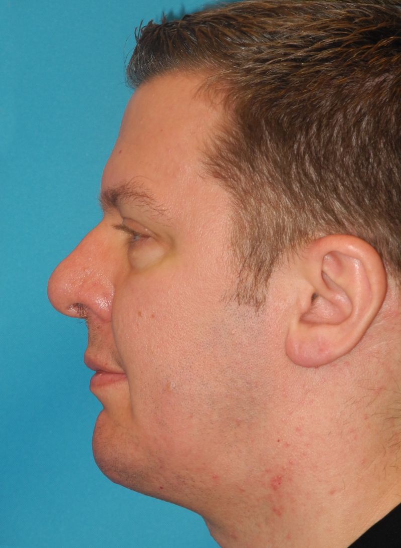 Chin Implant case #4374