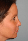 Rhinoplasty case #3690