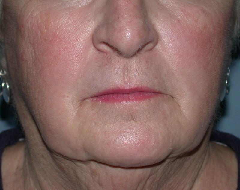 CO2 Laser Resurfacing case #5411