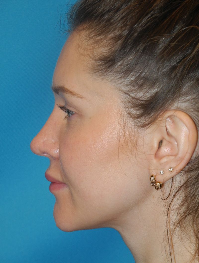 Revision Rhinoplasty case #3435