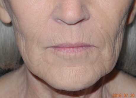 CO2 Laser Resurfacing case #4679