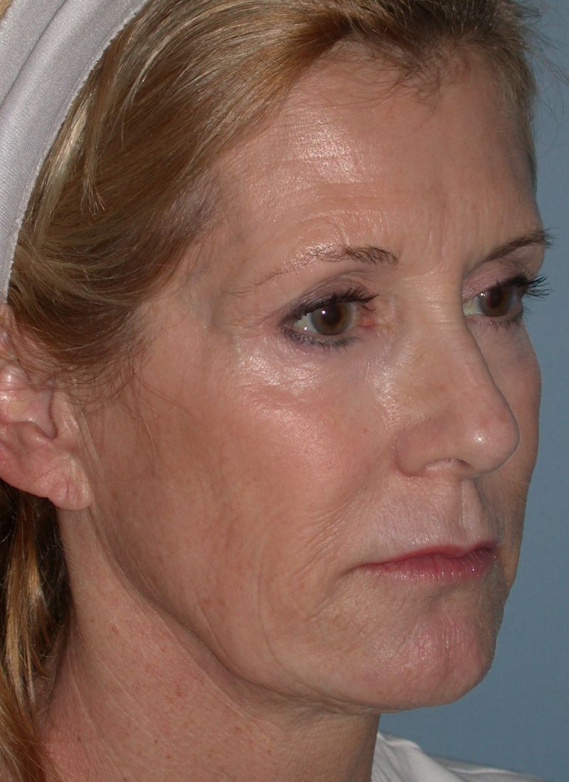 CO2 Laser Resurfacing case #4683