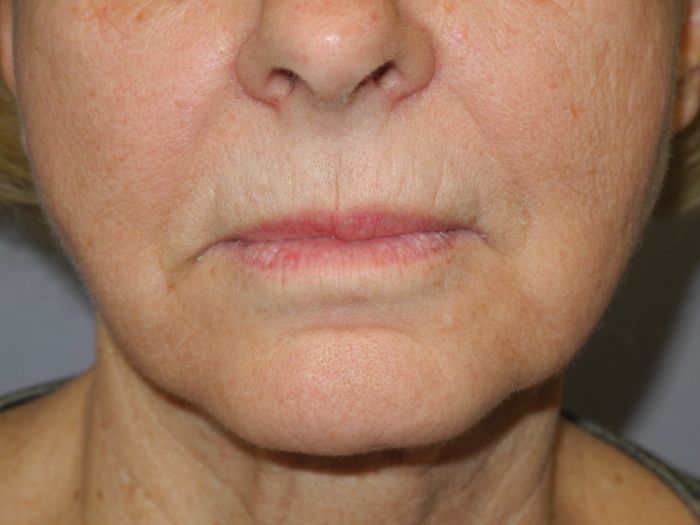 CO2 Laser Resurfacing case #4684