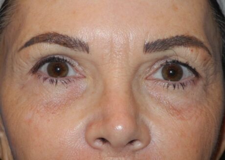 CO2 Laser Resurfacing case #4686