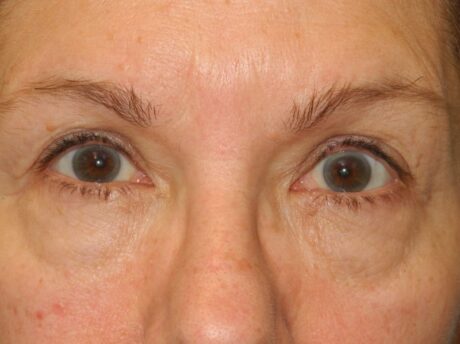 CO2 Laser Resurfacing case #4752