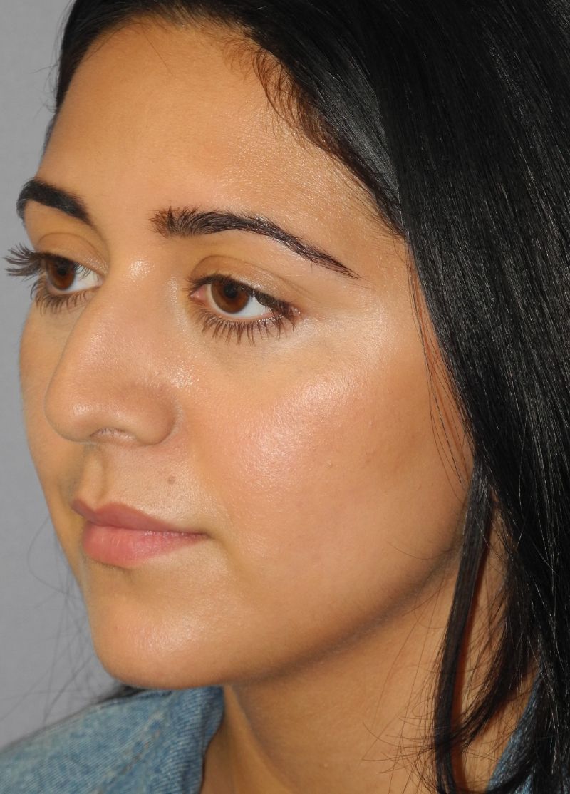 Rhinoplasty case #3518