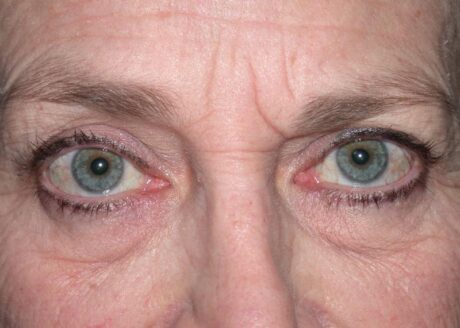 Blepharoplasty case #4790