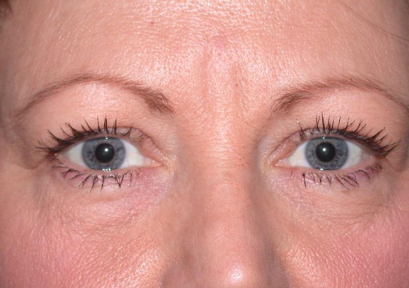 Blepharoplasty case #4819