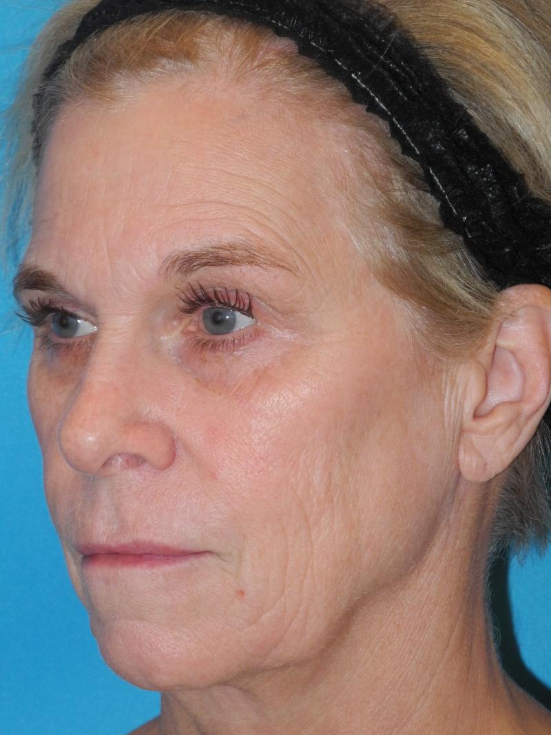 CO2 Laser Resurfacing case #4754