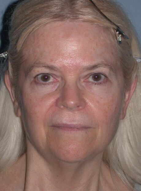 Blepharoplasty case #6470