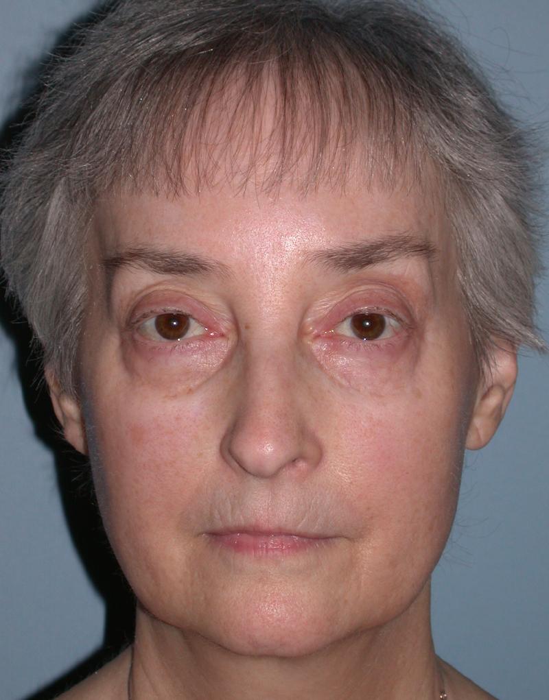 Blepharoplasty case #4858