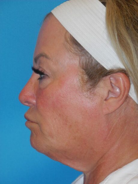 CO2 Laser Resurfacing case #4756