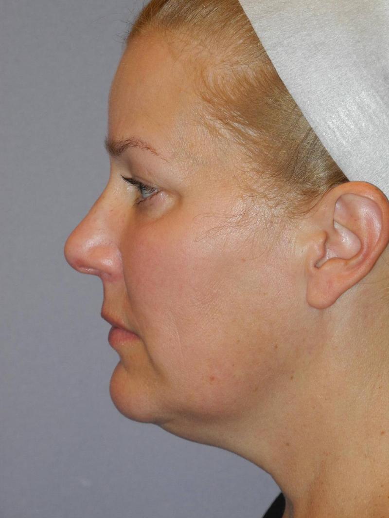 Facelift case #4895