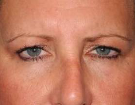 Blepharoplasty case #3877