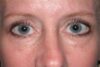 Blepharoplasty case #4941