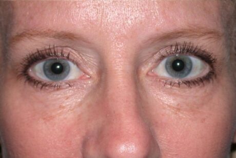 Blepharoplasty case #4941