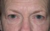 Blepharoplasty case #4948