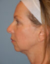 Blepharoplasty case #4966