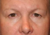 Blepharoplasty case #3896