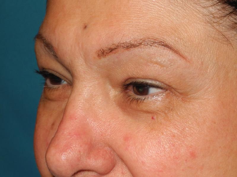 Blepharoplasty case #5141