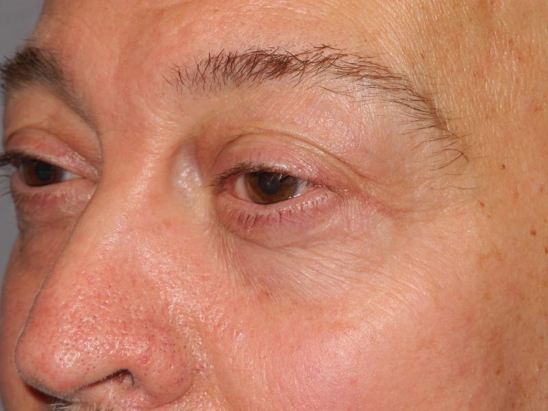 Blepharoplasty case #5148