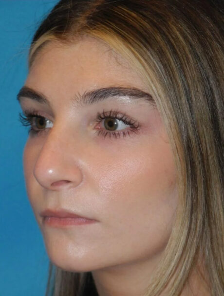 Rhinoplasty case #3521