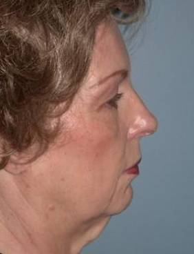 Blepharoplasty case #4053