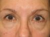 Blepharoplasty case #5167