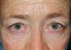 Blepharoplasty case #5175