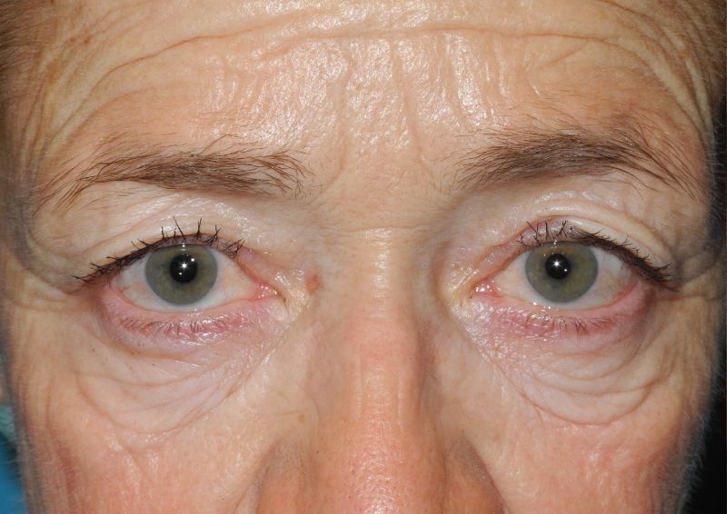 Blepharoplasty case #5175