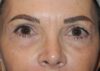 Blepharoplasty case #5186