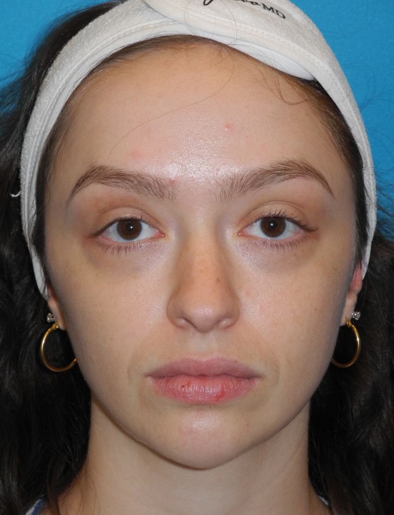 Blepharoplasty case #5197