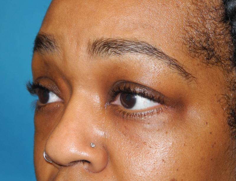 Blepharoplasty case #5204