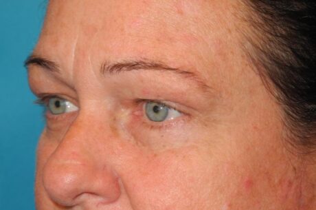 Blepharoplasty case #5225