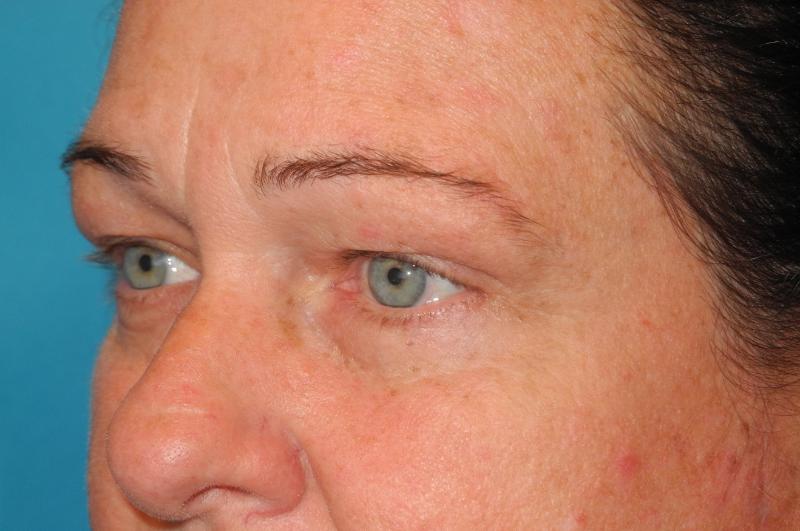 Blepharoplasty case #5225