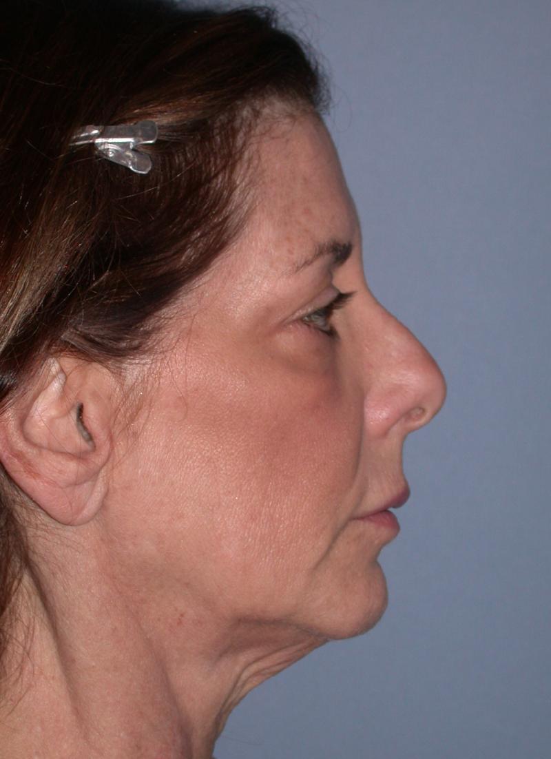 Neck Lift case #5321