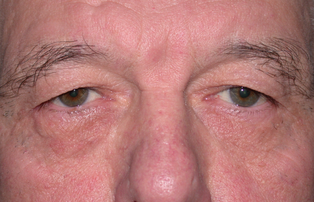 Blepharoplasty case #4777