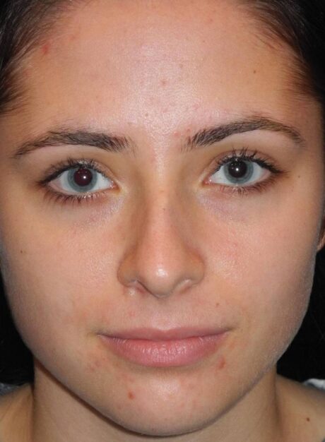 Rhinoplasty case #3683