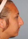 Rhinoplasty case #3514