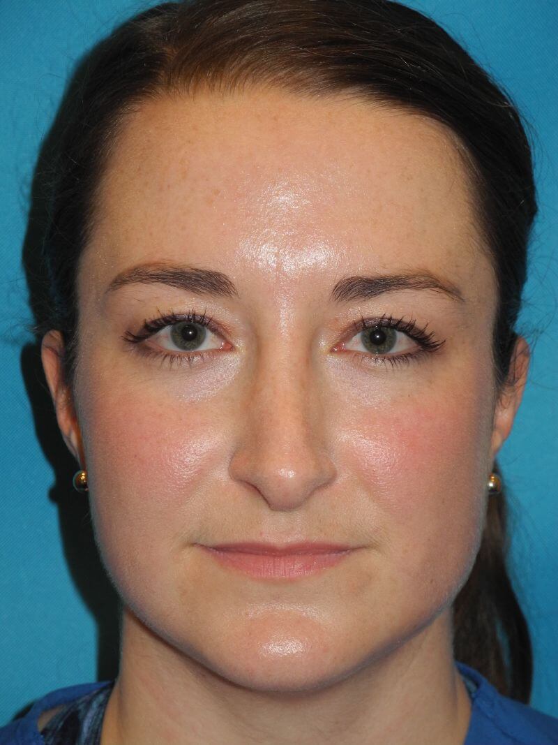 Revision Rhinoplasty case #3453