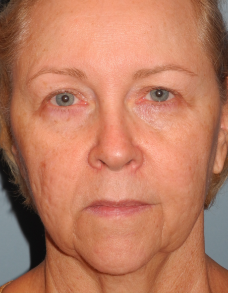 Blepharoplasty case #4986