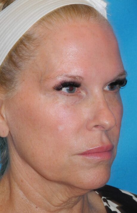 Blepharoplasty case #3927