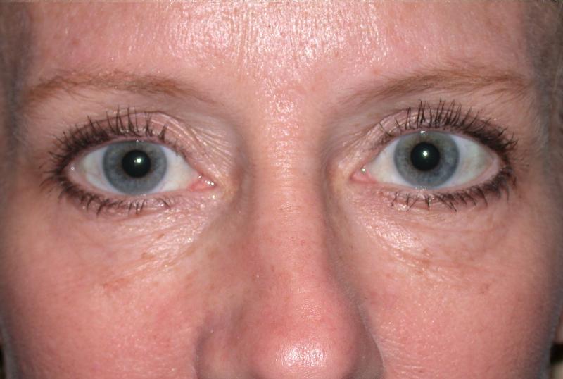 Blepharoplasty case #6474