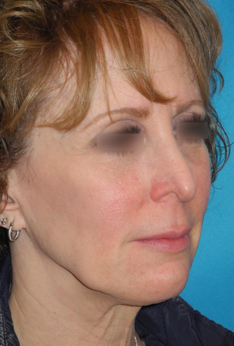 Revision Rhinoplasty case #3464