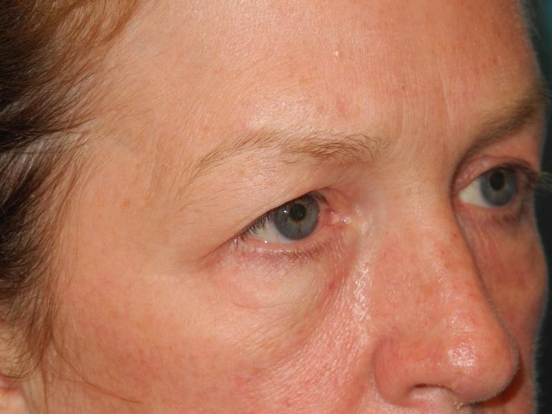 Blepharoplasty case #4024